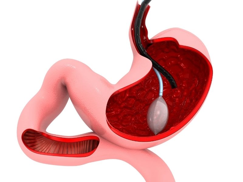 mide-balonuyla-zayiflamak-mumkun-mu